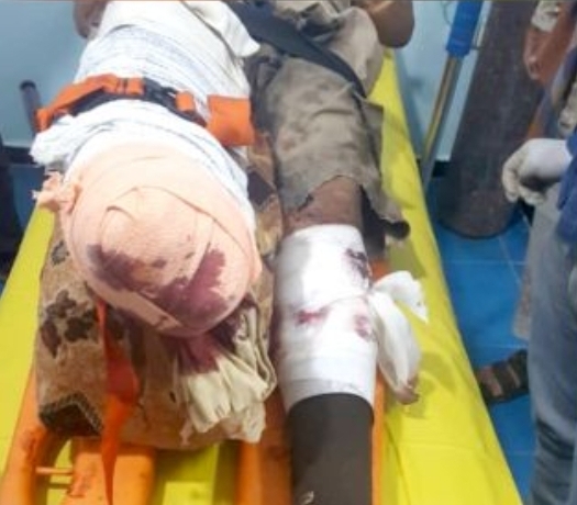 شاهد بالصور....بُترت قدمه اليمنى.. إصابة أحد مهندسي "مسام" بانفجار لغم حوثي بالوازعية