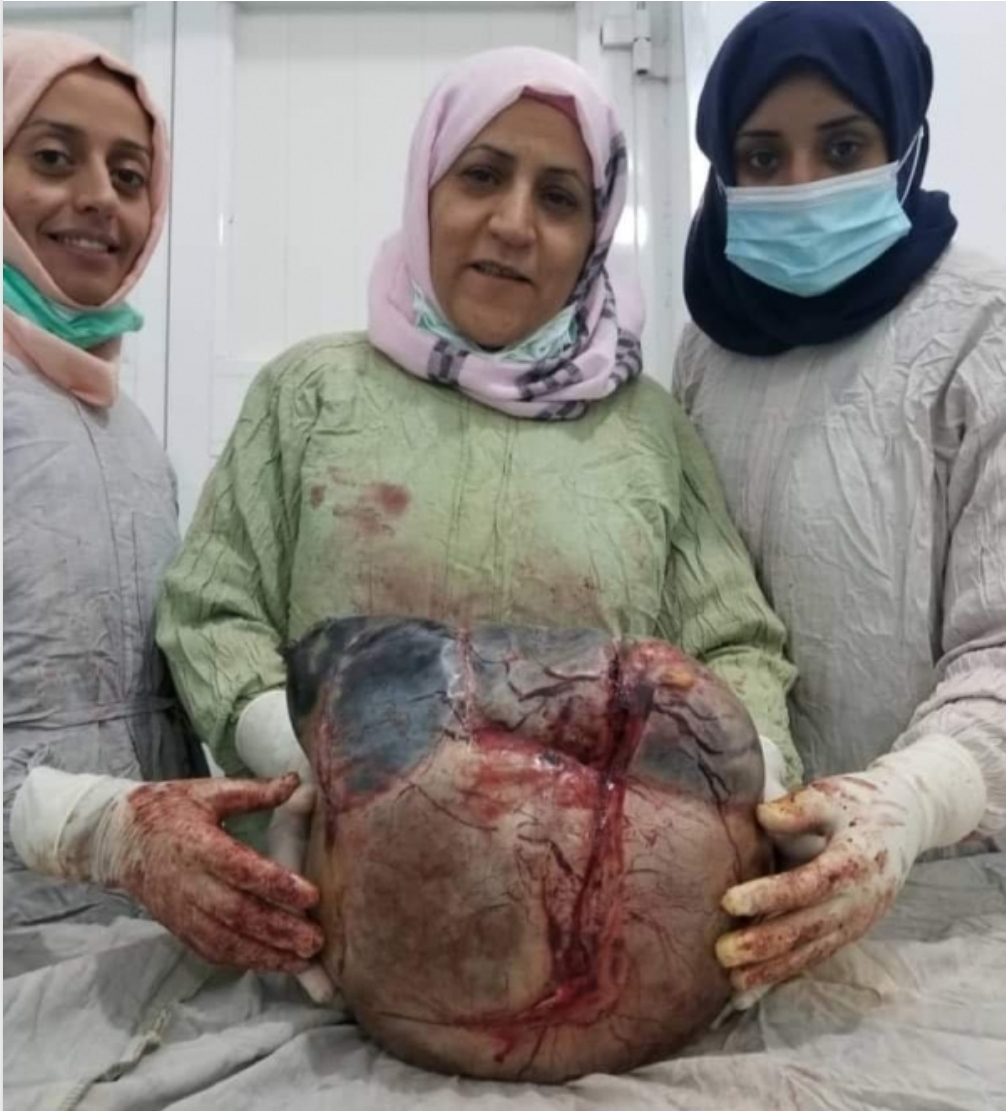 شاهد بالصور...البرفسور علية شعيب مع فريقها الطبي تستأصل ورم وزنه 10 كيلو من مبيض أمرأة 