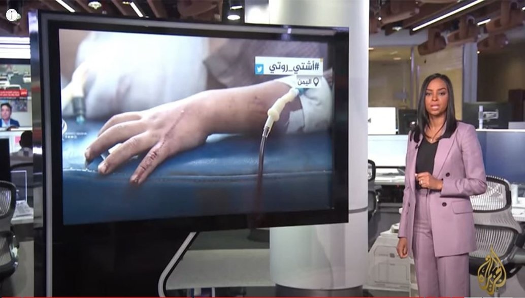 سقوط أخلاقي جديد لقناة الجزيرة إثر تغطيتها قصة "طفل الروتي" في اليمن