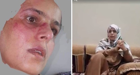 الحوثيون يعتدون على ناشطة وصفت زعيمهم بـ"الجرو" (صورة)