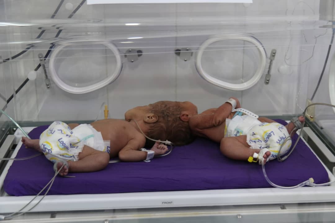 بعملية قيصرية نادرة...ولادة توأم سيامي ملتصق بالرأس في حضرموت (صور)