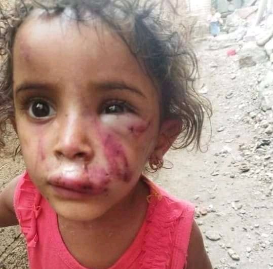 تعز.. امرأة تعتدي على طفلتها بشكل وحشي والسبب والدها! - (صور)