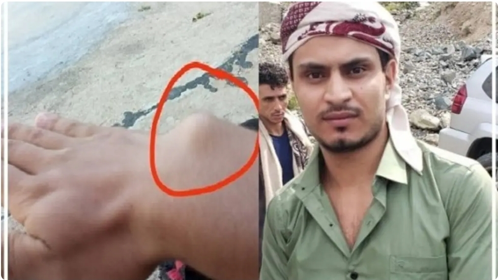 كسرو قفصه الصدري و رجله وتركوه دون علاج...معتقل سابق يحكي صنوف العذاب في سجون الحوثي 