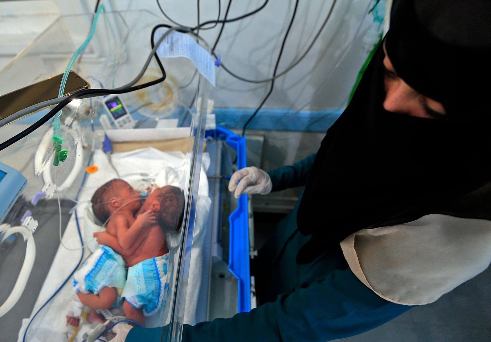 بالصور...امرأة يمنية تلد توأمان سياميان بقلب واحد ورئتين