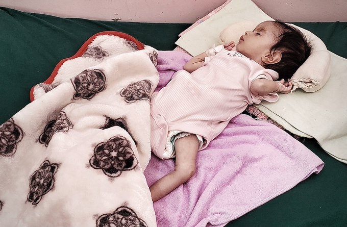الصحة العالمية: 3 من كل 4 أطفال دون الخامسة يعانون من سوء التغذية في اليمن
