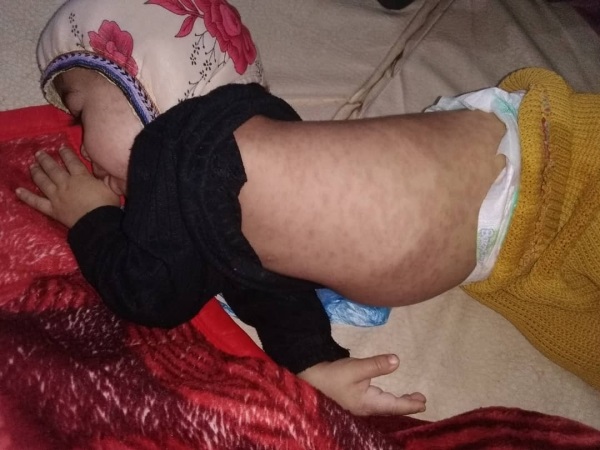 الصحة العالمية: 16 حالة وفاة من أصل 1600 إصابة بالحصبة في محافظة يمنية