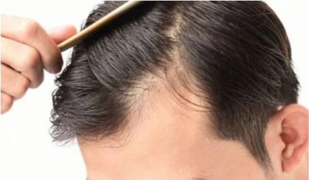 اسباب تساقط الشعر من الامام وكيفية علاج المشكلة