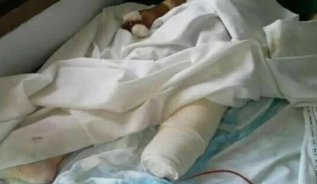 إصابة طفل إثر انفجار مقذوف حوثي جنوب اليمن